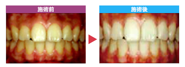 セルフホワイトニング施術事例 A様