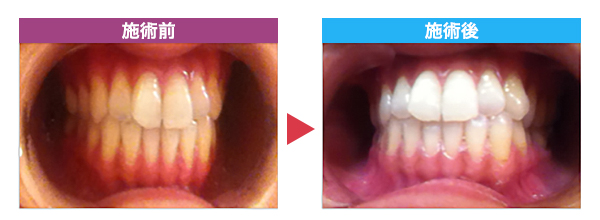セルフホワイトニング施術事例 B様