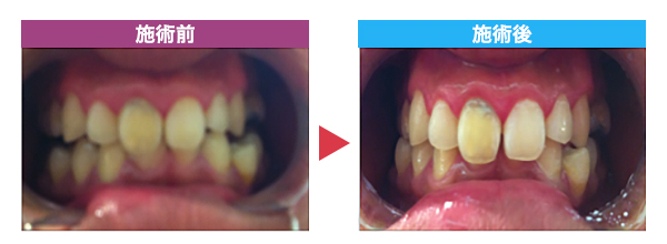 セルフホワイトニング施術事例 C様