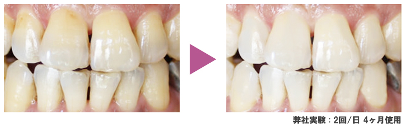 歯磨き粉成分グリチルリチン酸ジカリウム