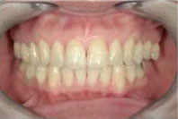 市販品ホームホワイトニングの歯の白さ