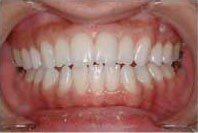 BeautySmileホワイトニングの歯の白さ