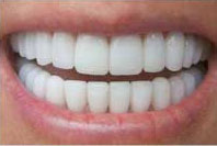 歯科オフィスホワイトニングの歯の白さ